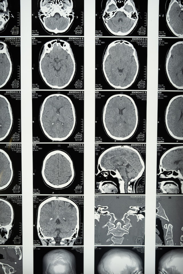 Epilepsia: Testele imagistice. RMN, CT, PET, MEG, SPECT -epiexpert-epilepsia